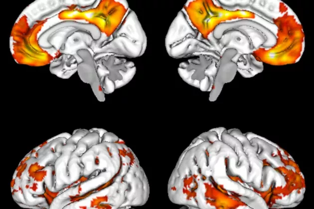 The image illustrates where in the brain the earliest signs of Alzheimer’s occur through accumulation of the β-amyloid protein