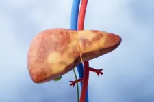 Fatty liver, illustration. Photo: iStock
